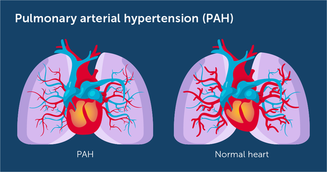 Pulmonary Arterial Hypertension (PAH)